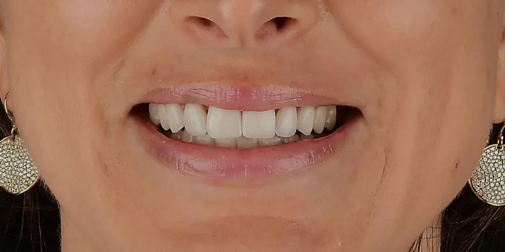 Before & After Gallery: Front Tooth Implants After 2 of 4