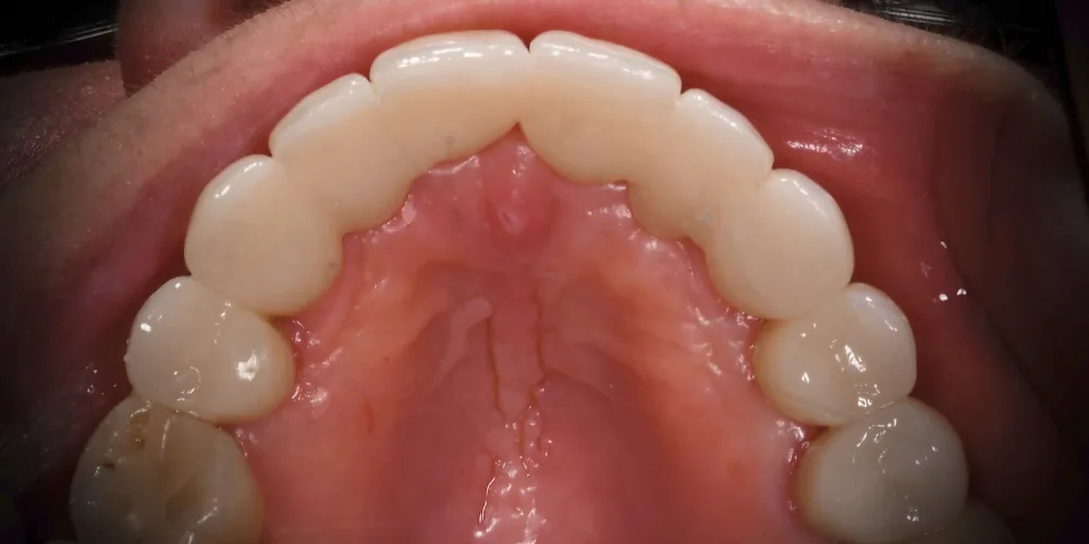 Before & After Gallery: Front Tooth Implants After 4 of 4