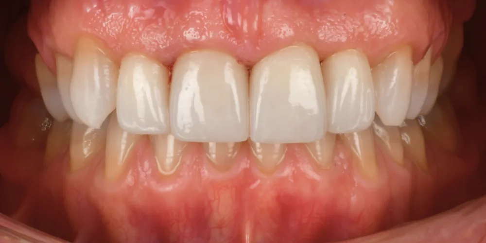 Before & After Gallery: Front Tooth Implants After 4 of 4