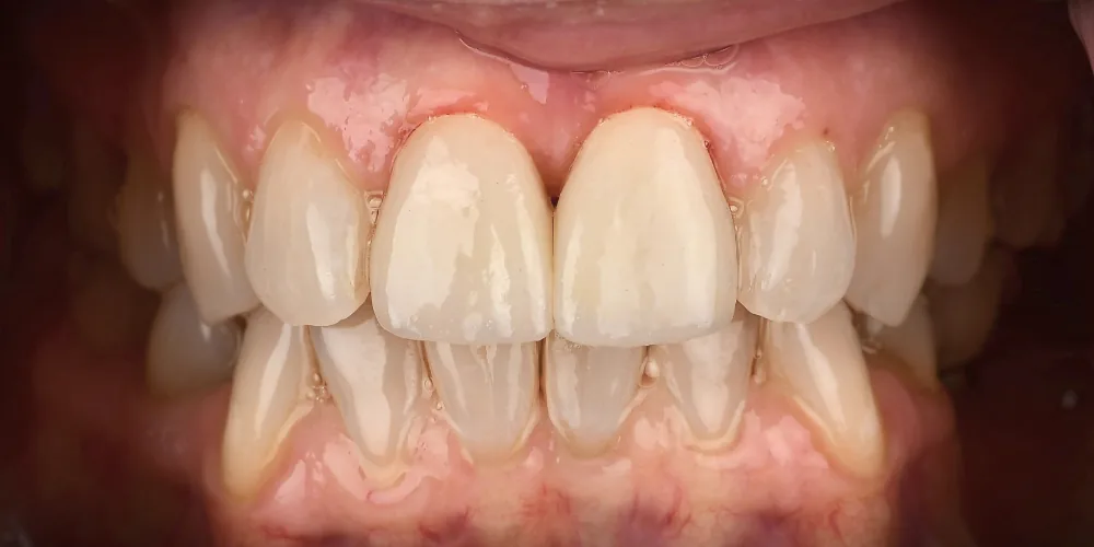 Before & After Gallery: Front Tooth Implants After 4 of 4