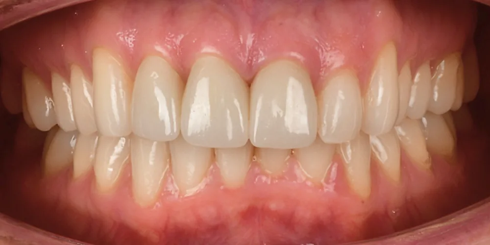 Before & After Gallery: Front Tooth Implants After 4 of 4