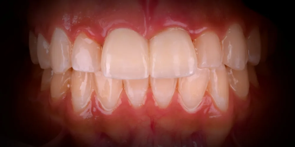 Before & After Gallery: Front Tooth Implants After 4 of 4