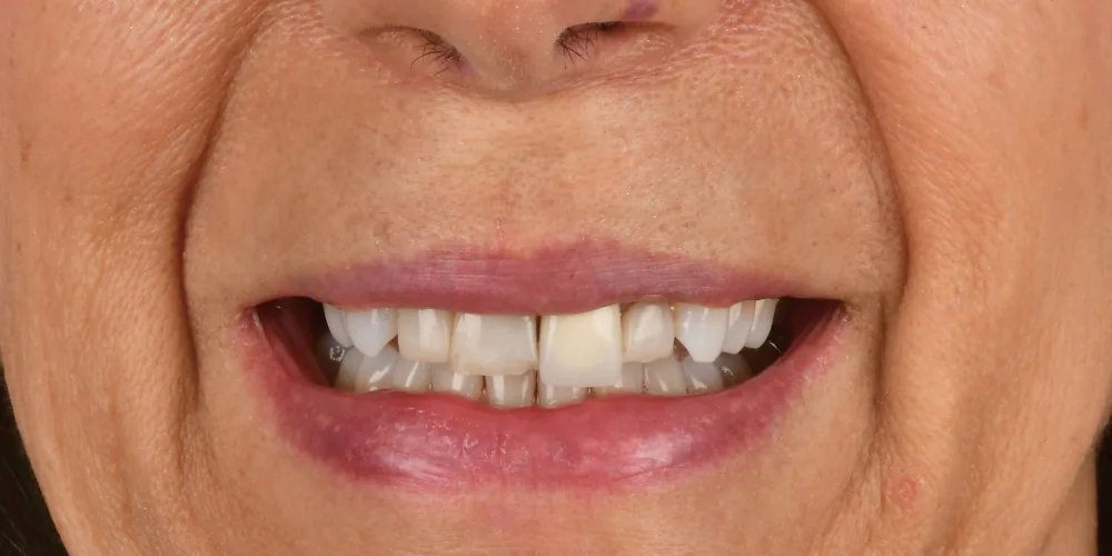 Before & After Gallery: Front Tooth Implants Before 1 of 4