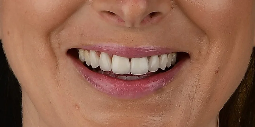 Before & After Gallery: Front Tooth Implants Before 1 of 4