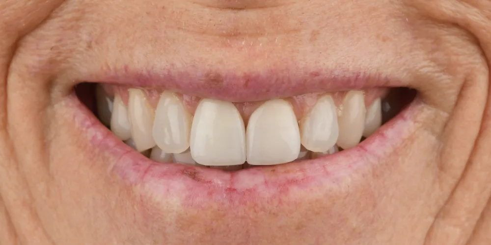 Before & After Gallery: Front Tooth Implants Before 1 of 4