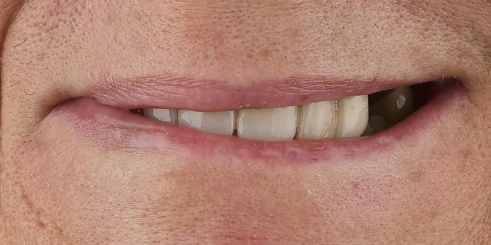 Before & After Gallery: Front Tooth Implants Before 1 of 4