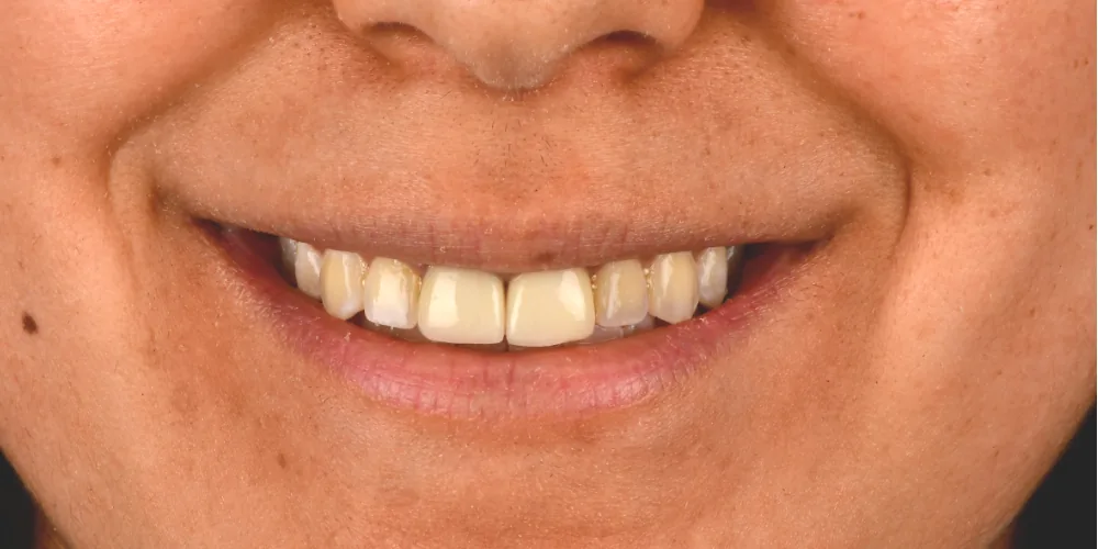 Before & After Gallery: Front Tooth Implants Before 1 of 4