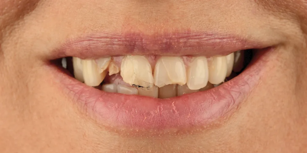 Before & After Gallery: Front Tooth Implants Before 1 of 4