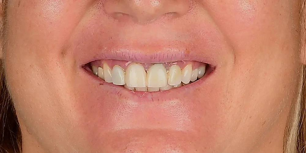 Before & After Gallery: Front Tooth Implants Before 1 of 4