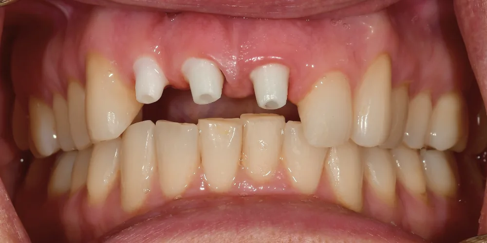 Before & After Gallery: Front Tooth Implants Before 3 of 4