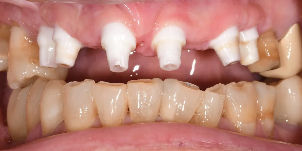 Before & After Gallery: Front Tooth Implants Before 3 of 4