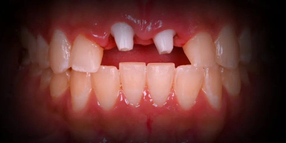 Before & After Gallery: Front Tooth Implants Before 3 of 4