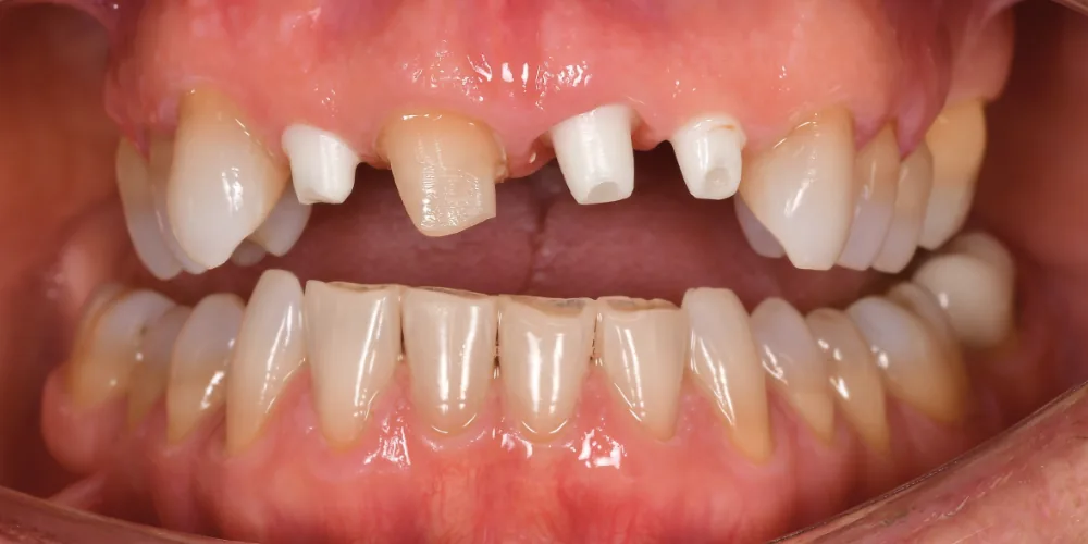 Before & After Gallery: Front Tooth Implants Before 3 of 4