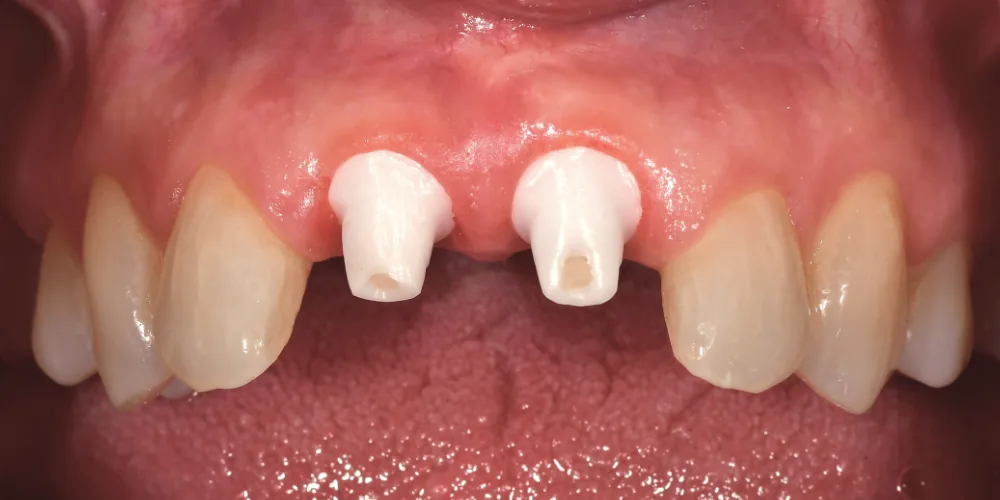 Before & After Gallery: Front Tooth Implants Before 3 of 4