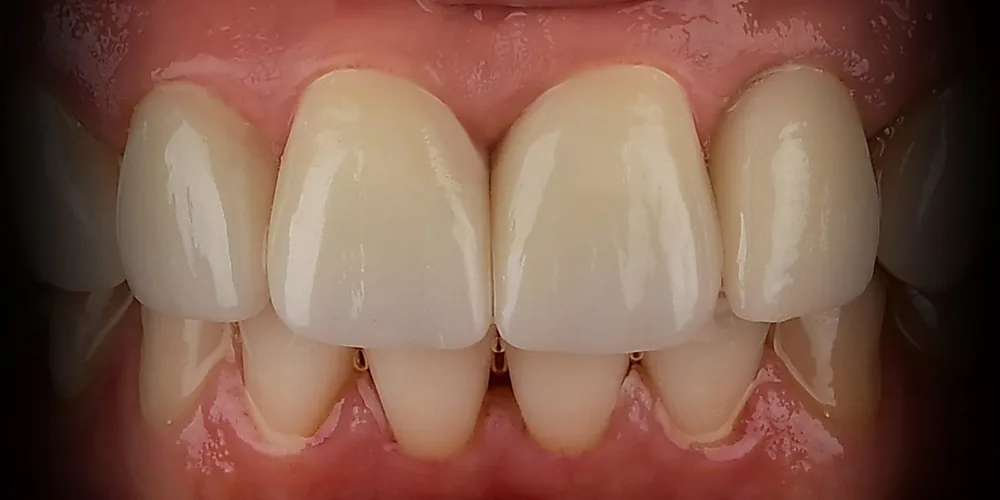 Before & After Gallery: Front Tooth Implants Final Implant with Crown 4 of 4