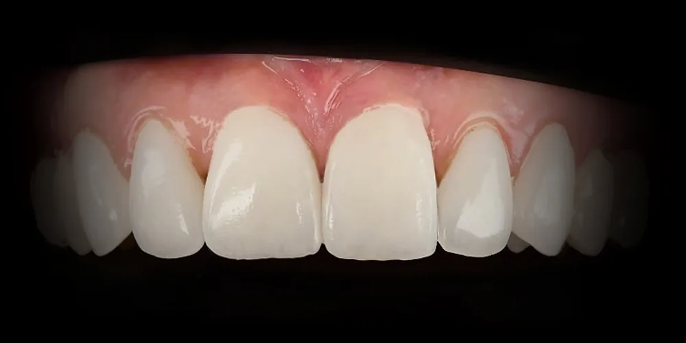Before & After Gallery: Front Tooth Implants Final Implant with Crown 4 of 4