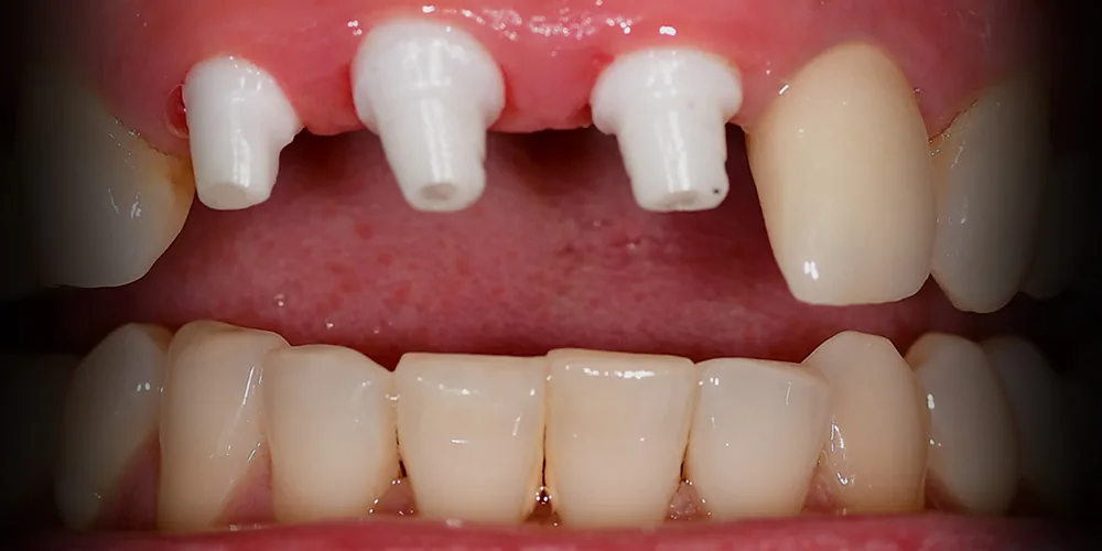 Before & After Gallery: Front Tooth Implants Implant Placed 3 of 4