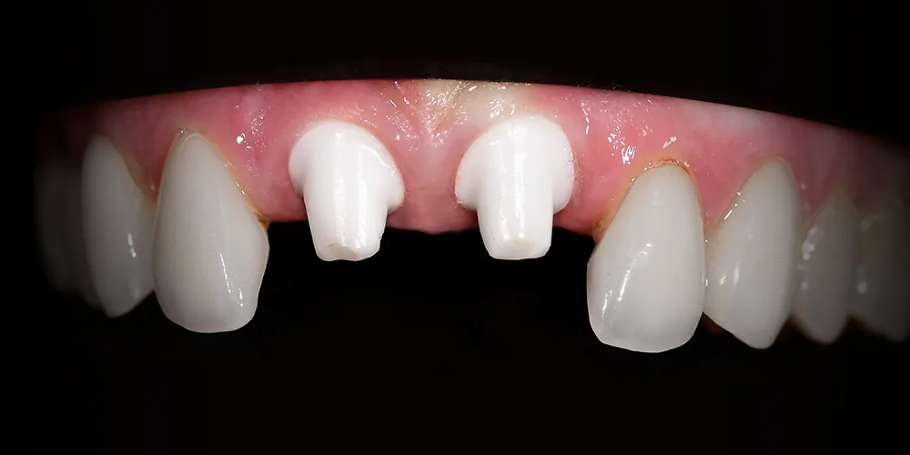 Before & After Gallery: Front Tooth Implants Implant Placed 3 of 4