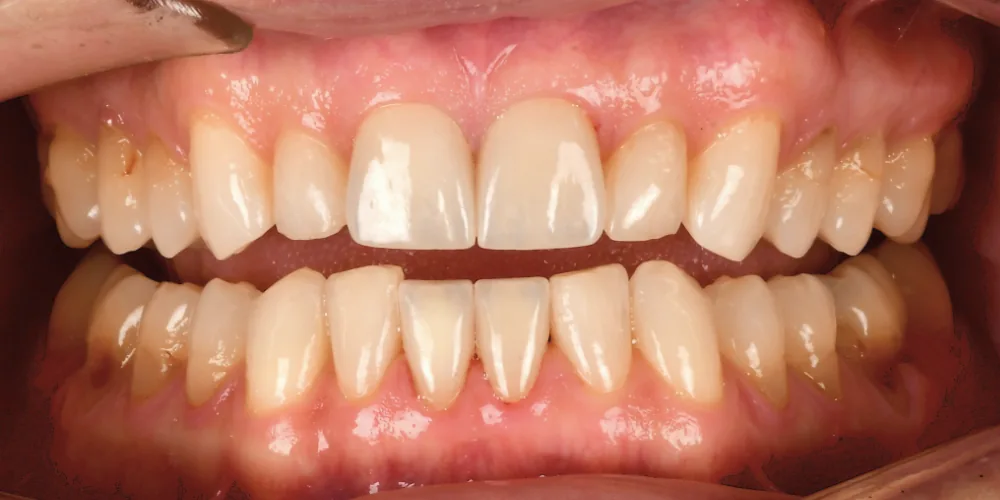 Before & After Gallery: Front Tooth Veneers After 4 of 4