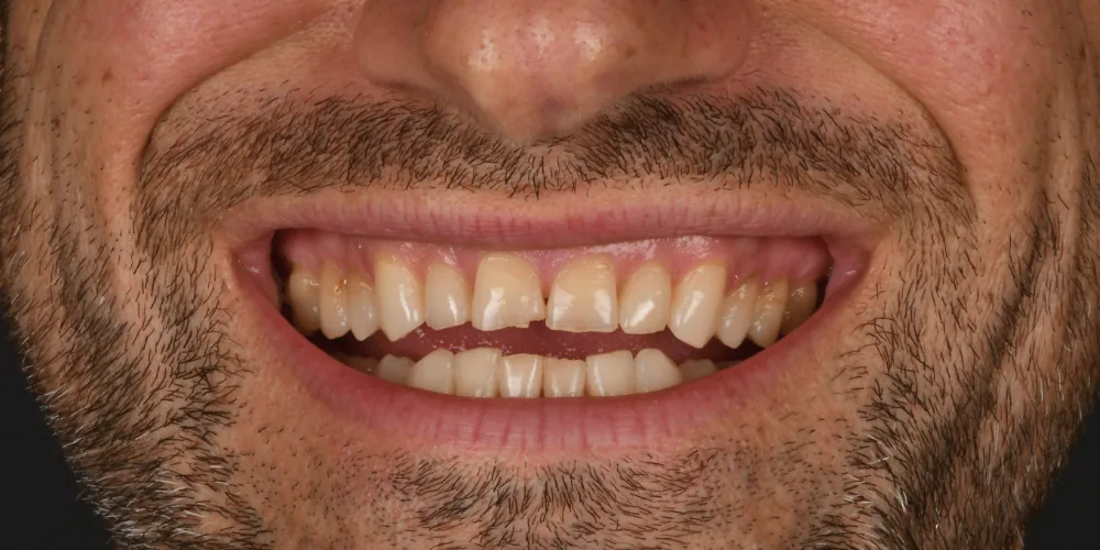 Before & After Gallery: Front Tooth Veneers Before 1 of 4