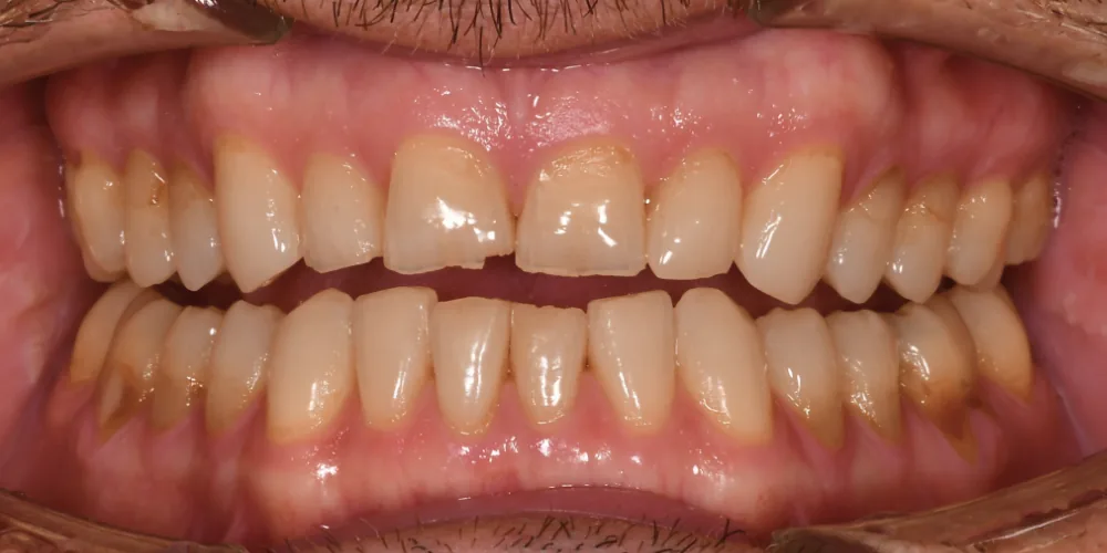 Before & After Gallery: Front Tooth Veneers Before 3 of 4