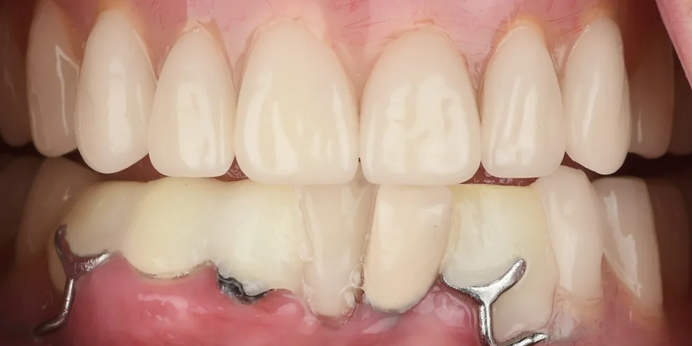 Before & After Gallery: Full Lower Arch Before 1 of 4
