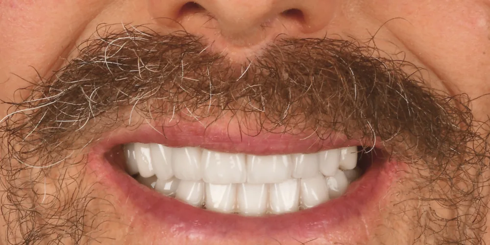 Before & After Gallery: Full Mouth Implants After 2 of 4