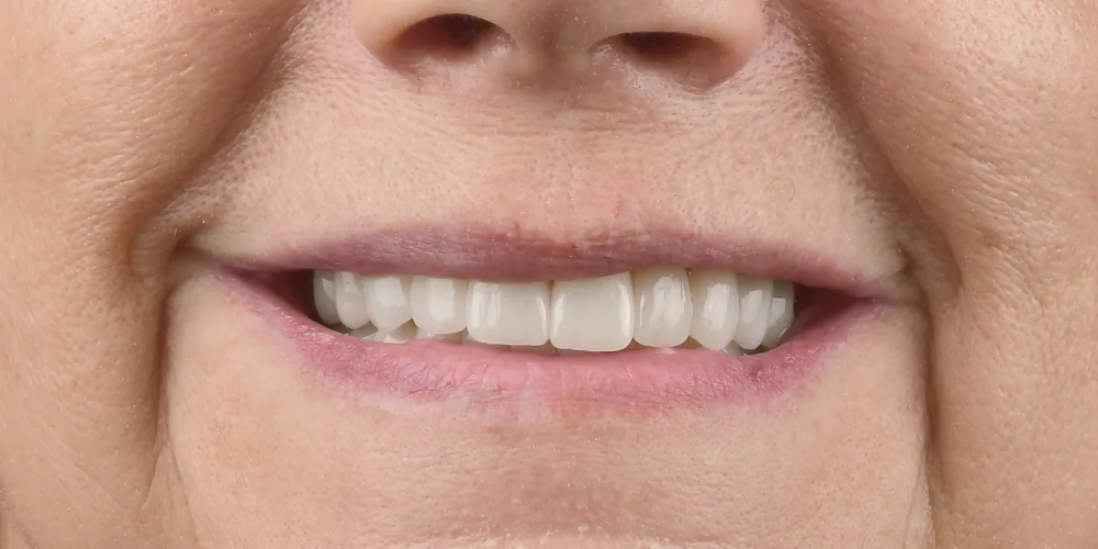 Before & After Gallery: Full Mouth Implants After 2 of 4