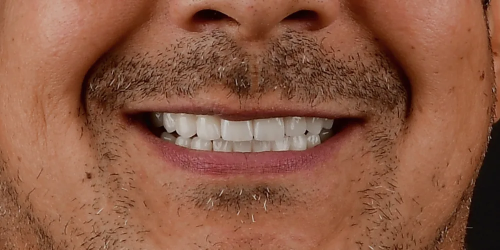 Before & After Gallery: Full Mouth Implants After 2 of 4