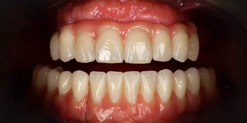Before & After Gallery: Full Mouth Implants After 4 of 4