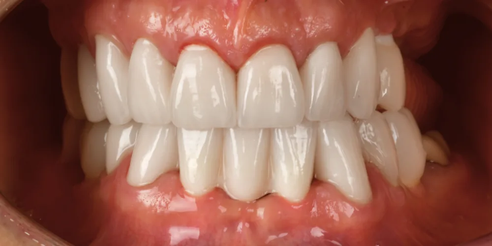 Before & After Gallery: Full Mouth Implants After 4 of 4