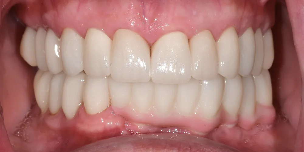 Before & After Gallery: Full Mouth Implants After 4 of 4