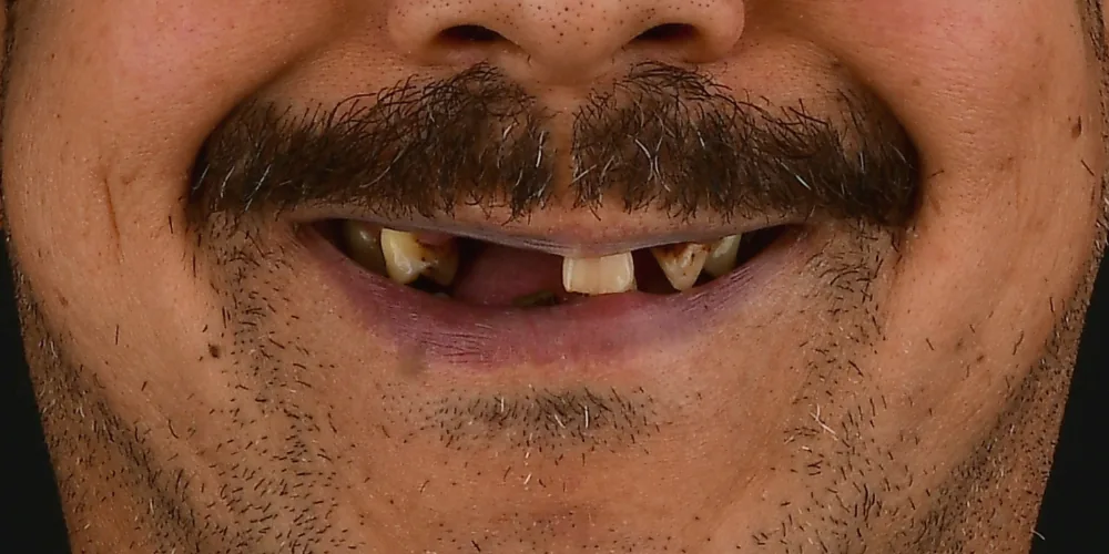Before & After Gallery: Full Mouth Implants Before 1 of 4