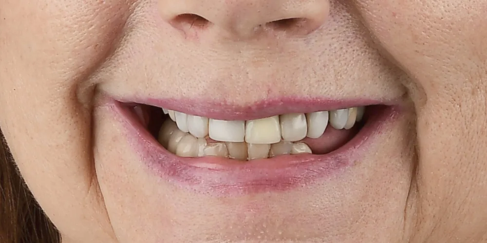 Before & After Gallery: Full Mouth Implants Before 1 of 4