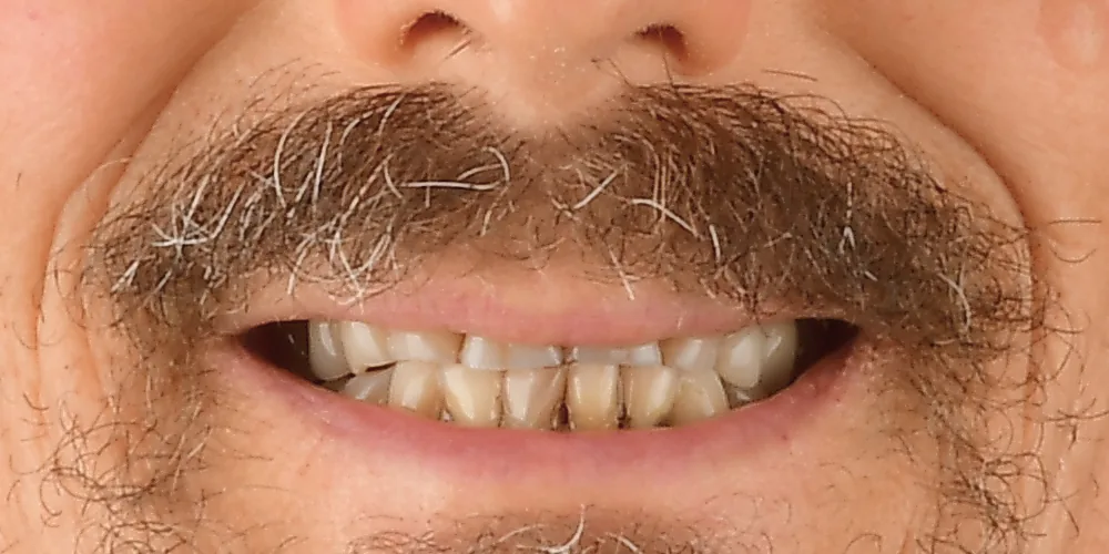 Before & After Gallery: Full Mouth Implants Before 1 of 4
