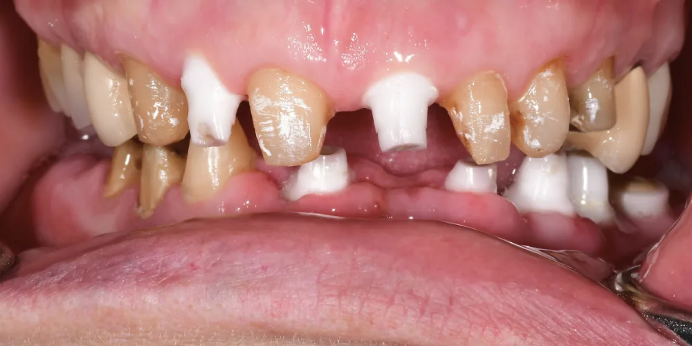 Before & After Gallery: Full Mouth Implants Before 3 of 4