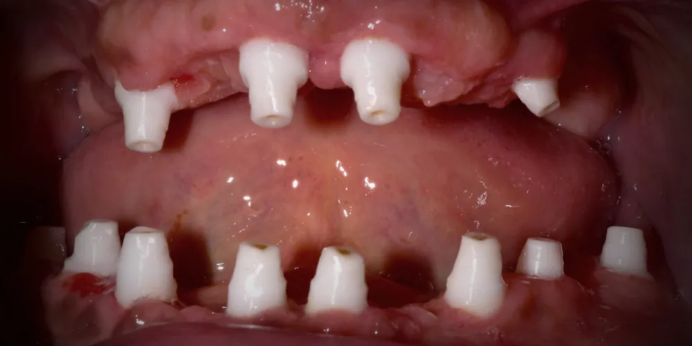Before & After Gallery: Full Mouth Implants Before 3 of 4