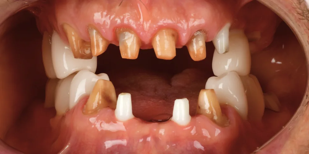 Before & After Gallery: Full Mouth Implants Before 3 of 4
