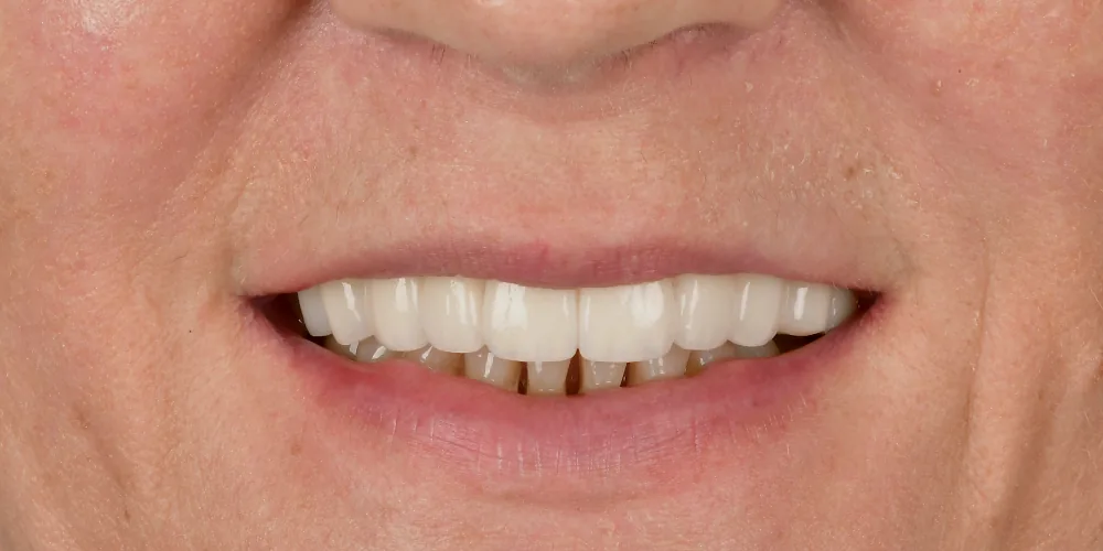 Before & After Gallery: Full Upper Arch Implants After 2 of 4