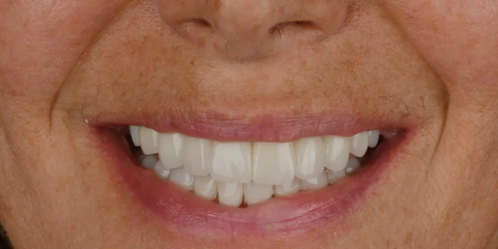 Before & After Gallery: Full Upper Arch Implants After 2 of 4
