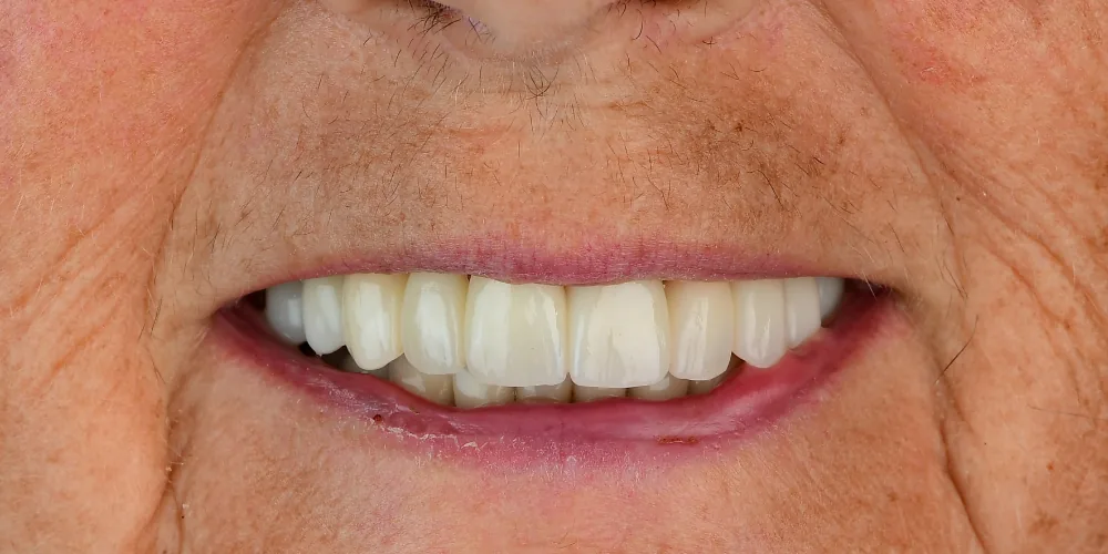 Before & After Gallery: Full Upper Arch Implants After 2 of 4
