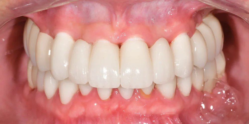 Before & After Gallery: Full Upper Arch Implants After 4 of 4