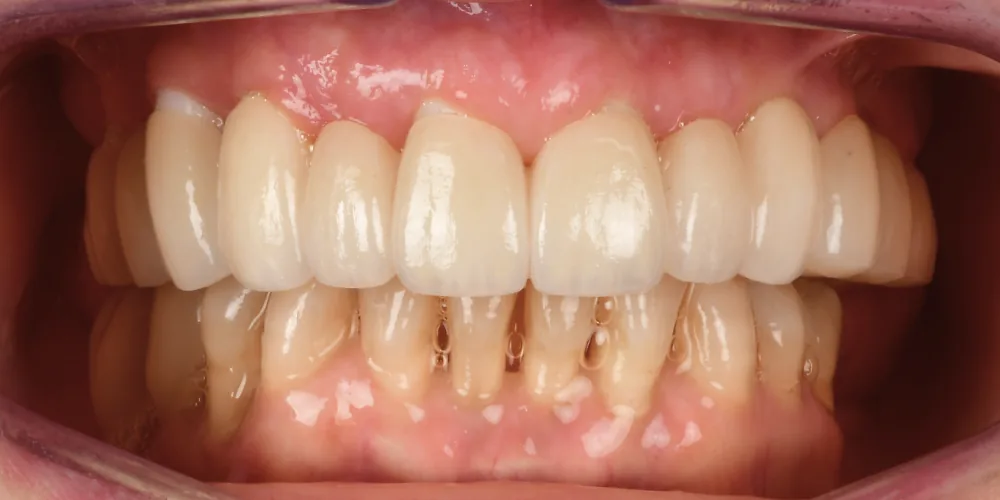 Before & After Gallery: Full Upper Arch Implants After 4 of 4