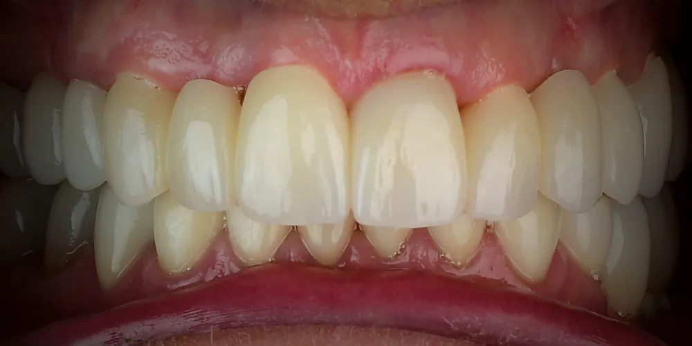 Before & After Gallery: Full Upper Arch Implants After 4 of 4