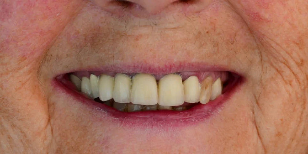Before & After Gallery: Full Upper Arch Implants Before 1 of 4