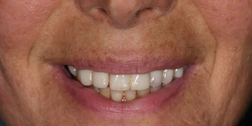 Before & After Gallery: Full Upper Arch Implants Before 1 of 4