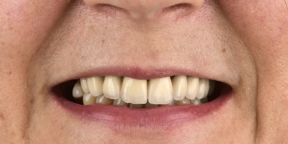 Before & After Gallery: Full Upper Arch Implants Before 1 of 4