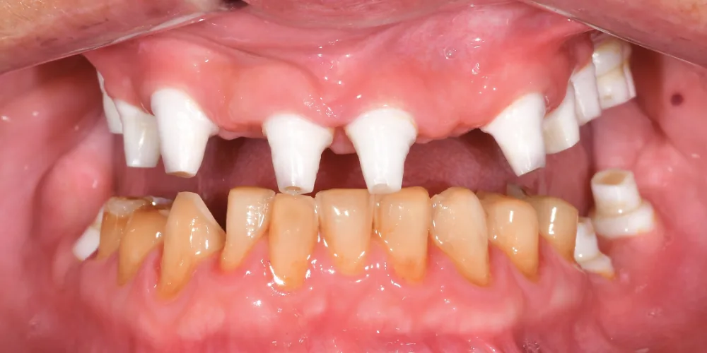 Before & After Gallery: Full Upper Arch Implants Before 3 of 4