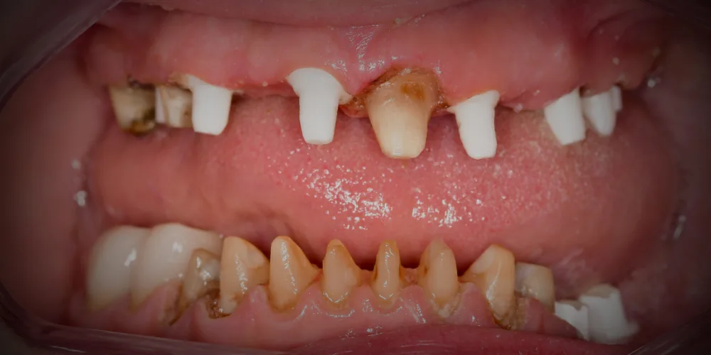Before & After Gallery: Full Upper Arch Implants Before 3 of 4