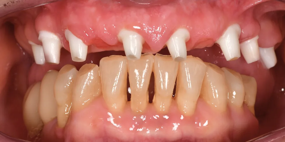 Before & After Gallery: Full Upper Arch Implants Before 3 of 4